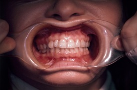 teeth.stretch.frontal.web_